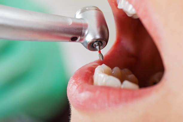 Best Emergency Dentist for Lost Fillings or Crowns in Weston Lakes, TX